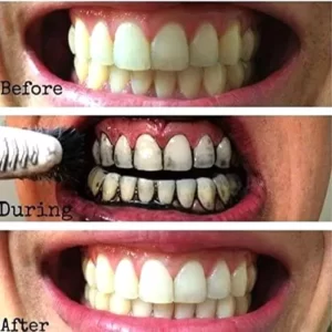 A woman's teeth are shown before and after using Dr.Rashel whitening.