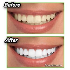 A woman's teeth before and after using Miracle Teeth Whitener Powder.