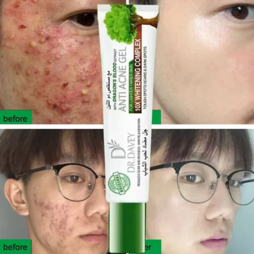 Dragon Blood Anti Acne Gel Skin Care